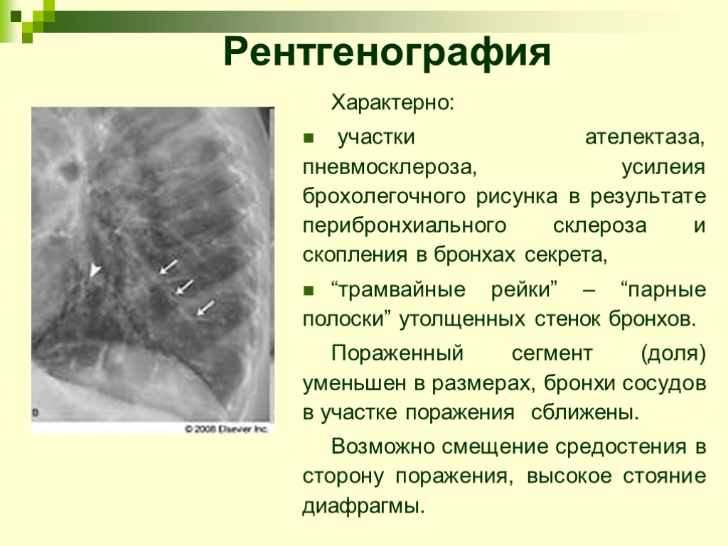 Характерно: участки ателектаза, пневмосклероза, усилеия брохолегочного рисунка в результате перибронхиального склероза и скопления в